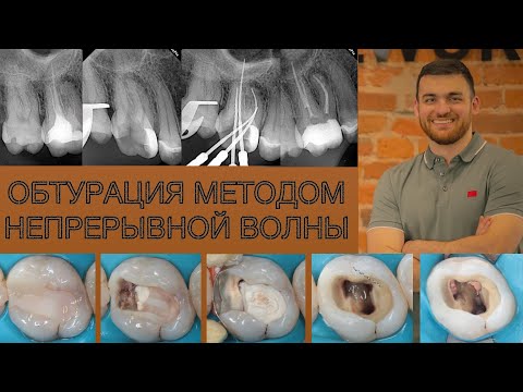 Видео: Пломбирование корневых каналов моляра (обтурация 1,6 зуба) методом непрерывной волны