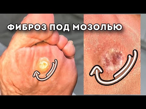 Видео: Разрастание болезненной фиброзной ткани у основания сухой мозоли