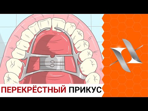 Видео: ПЕРЕКРЁСТНЫЙ прикус | Причины. Последствия. Лечение.