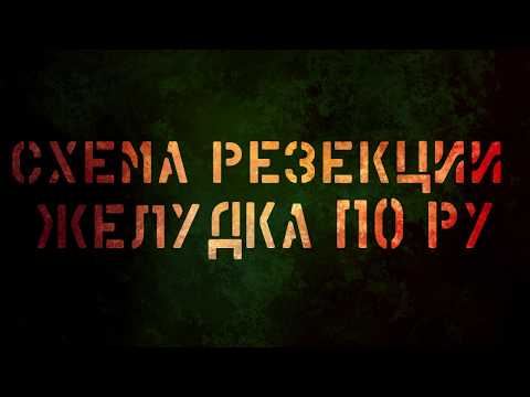 Видео: Схема резекции желудка по Ру
