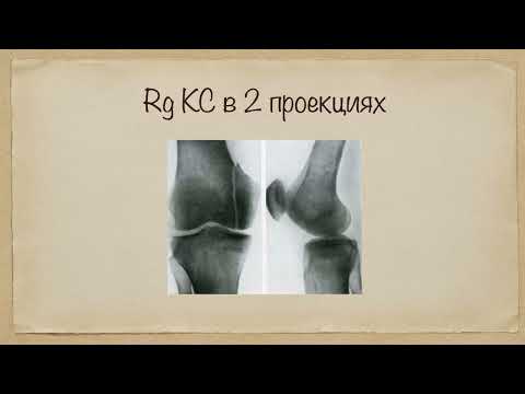 Видео: 2.5. Переломы мыщелков бедра и большеберцовой кости: классификация, диагностика, лечение.