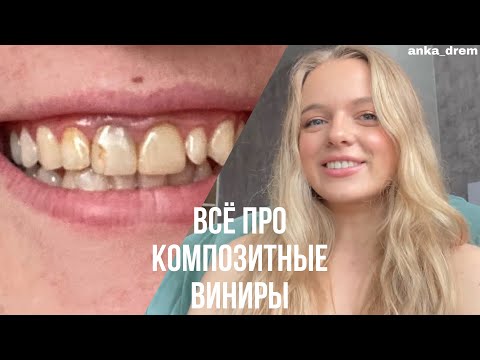 Видео: ВСЁ ПРО КОМПОЗИТНЫЕ ВИНИРЫ // БРУКСИЗМ