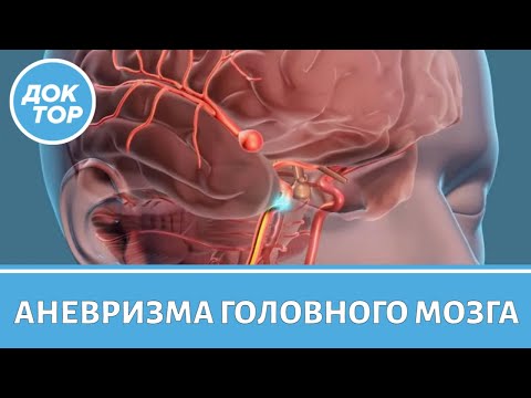 Видео: Как жить с аневризмой головного мозга