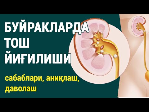 Видео: Буйракларда тош йиғилиши: сабаблари, аниқлаш ва даволаш