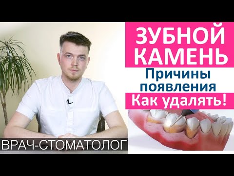 Видео: Зубной камень причины появления и как удалять. Как появляется зубные отложения из зубного налета.