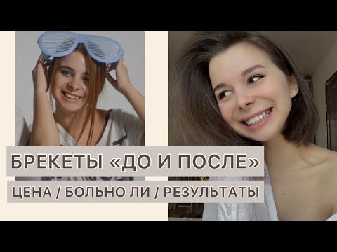 Видео: БРЕКЕТЫ ДО И ПОСЛЕ (МОЯ ИСТОРИЯ) / ВСЁ ПРО БРЕКЕТЫ / ИСТОРИЯ МОИХ ЗУБОВ / БОЛЬНО ЛИ