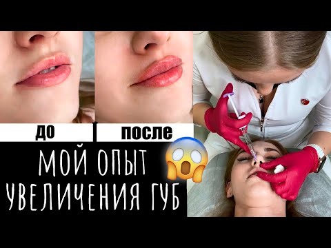 Видео: ПЕРВОЕ УВЕЛИЧЕНИЕ ГУБ / ДО и ПОСЛЕ 👄 вся правда о процедуре и реабилитации ❗️