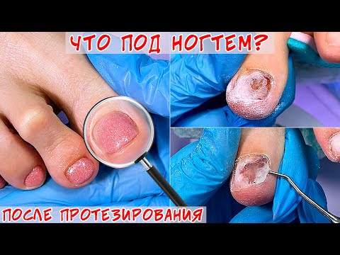 Видео: Протезирование ногтевой пластины / Три недели спустя