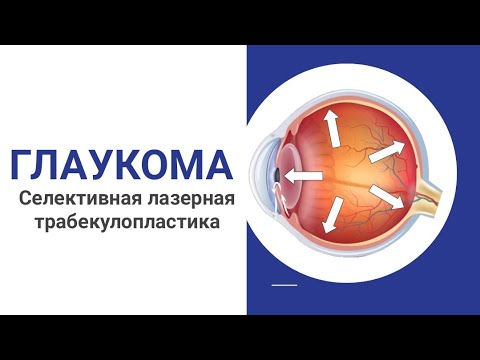 Видео: Селективная лазерная трабекулопластика