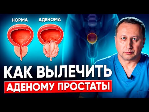 Видео: Аденома простаты. Симптомы, профилактика, диагностика и методы лечение. Комментарии врача уролога.