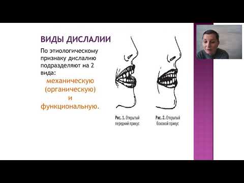 Видео: Дислалия и ринолалия