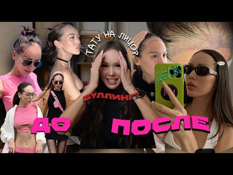 Видео: МОЯ ИСТОРИЯ ПЕРЕСАДКИ ВОЛОС!