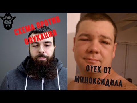 Видео: От миноксидила опухло лицо и веки, 4 решения.