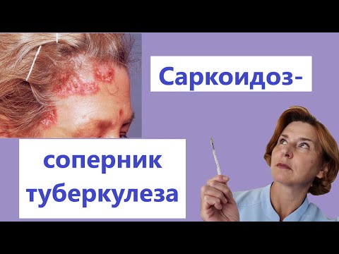Видео: Саркоидоз, симптомы