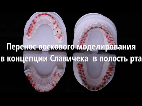 Видео: Mock-Up длительного ношения | Перенос воскового моделирования в полость рта.