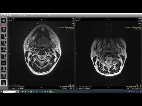 Видео: Отек костного мозга из-за неудачной мануальной терапии шеи