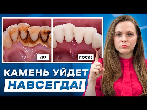 Видео: Как удалить зубной камень ДОМА? Лучшая методика в 2024!