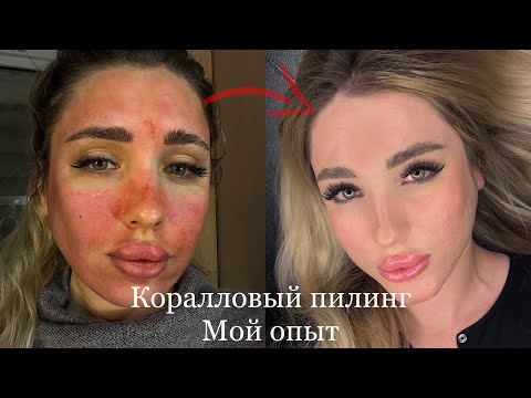 Видео: Коралловый пилинг | заживление по дням + результат