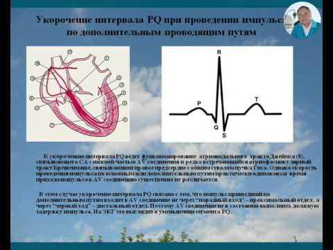 Видео: Фактор внезапной смерти: укороченный интервал P-Q. Воробьев Л.В.