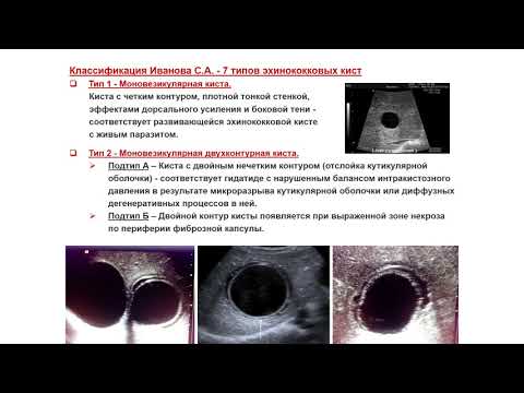 Видео: УЗИ. Доктор Иогансен. Выпуск 20. Эхинококковые поражения печени. Часть 2.