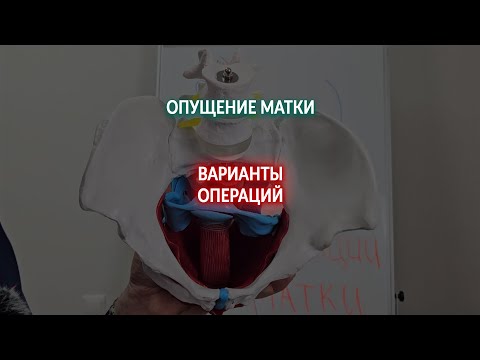 Видео: Виды фиксации матки при опущении
