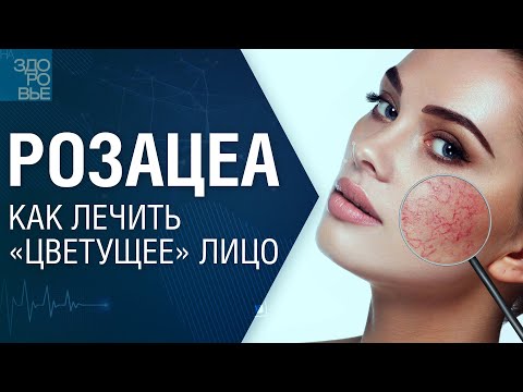 Видео: Розацеа. Как лечить «цветущее» лицо. На здоровье 28.12.2024