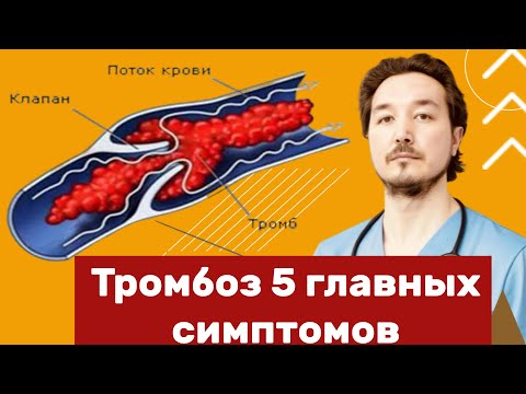 Видео: Главные симптомы тромбоза подкожных и глубоких вен. Факторы риска.