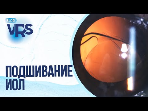 Видео: Фиксация ИОЛ