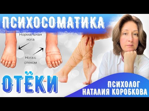 Видео: Отеки/Отечность/Психосоматика