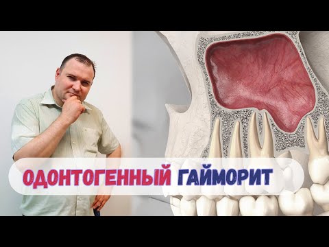Видео: Одонтогенный гайморит 👨‍⚕️ Вся правда