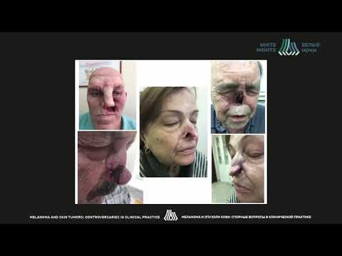 Видео: Mohs – хирургия в лечении плоскоклеточной карциномы кожи (Кушкин Д.Н.)