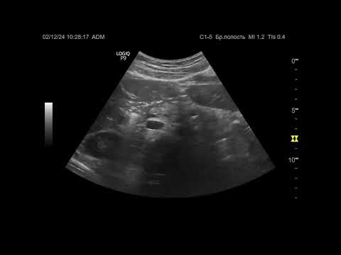 Видео: Ультразвуковая диагностика. Доктор Иогансен. Видеопримеры. Выпуск 108. Панкреатолитиаз (2).