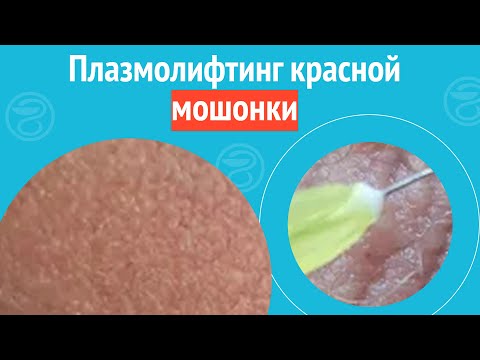 Видео: ✅ Плазмолифтинг красной мошонки. Клинический случай №1691