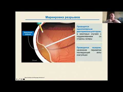 Видео: Отслойка сетчатки. Витреоретинальная хирургия