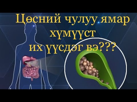 Видео: Цөсний чулуу ямар хүмүүст яагаад их үүсдэг вэ?