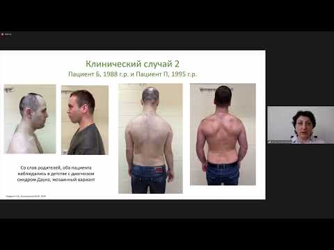 Видео: Хромосомные нарушения с минимальными фенотипическими проявлениями
