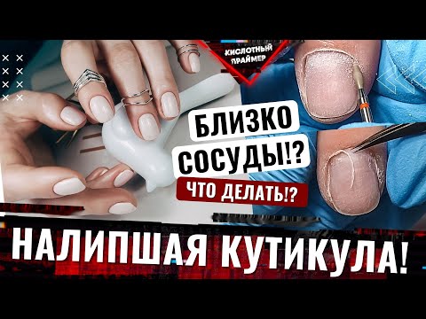 Видео: Сложная прилипшая кутикула😱 Близко сосуды у кутикулы! Близко расположены капилляры на ногтях 🩸
