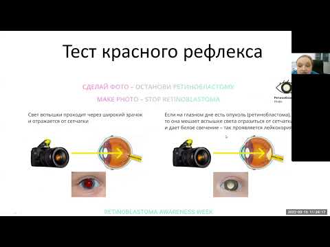Видео: Ретинобластома: как оценка красного рефлекса может помочь диагностике.