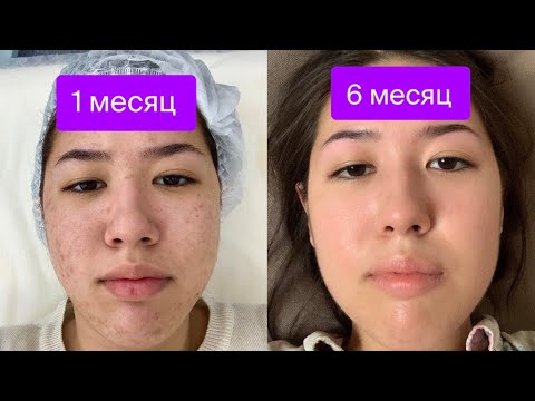 Видео: АКНЕКУТАН / КАК МЕНЯЛАСЬ МОЯ КОЖА ВО ВРЕМЯ ЛЕЧЕНИЯ АКНЕКУТАНОМ