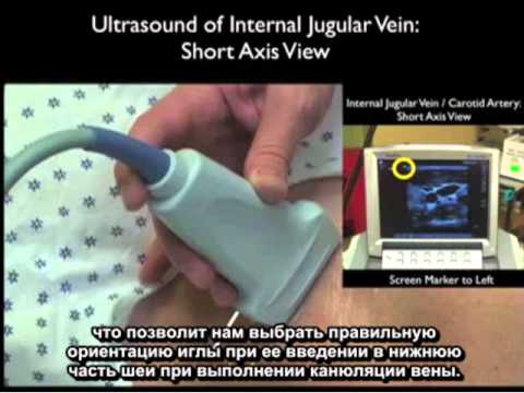 Видео: Порядок выполнения: центральный венозный доступ под контролем ультразвуковой визуализации (часть 1)