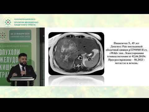 Видео: Химиоэмболизация и радиоэмболизация при метастазах колоректального рака: мнение за