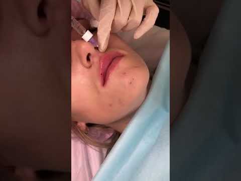 Видео: Губы бантик(5)