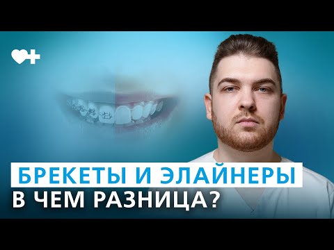 Видео: Брекеты и элайнеры. Что выбрать для исправления прикуса?