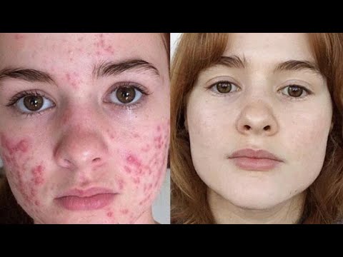 Видео: АКНЕ (УГРИ): Наружная терапия