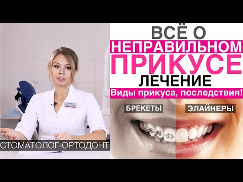 Видео: Все о неправильном прикусе: виды, исправление прикуса, кривых зубов брекетами, капами, элайнерами