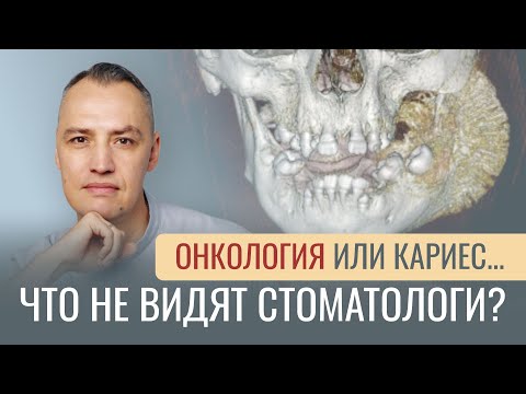 Видео: ОНКОЛОГИЯ ИЛИ КАРИЕС... Что не видят стоматологи?
