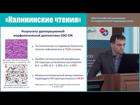 Видео: АНАЛИЗ РЕЗУЛЬТАТОВ ЛЕЧЕНИЯ БОЛЬНЫХ НЕЙРОЭНДОКРИННЫМИ ОПУХОЛЯМИ ПОДЖЕЛУДОЧНОЙ ЖЕЛЕЗЫ