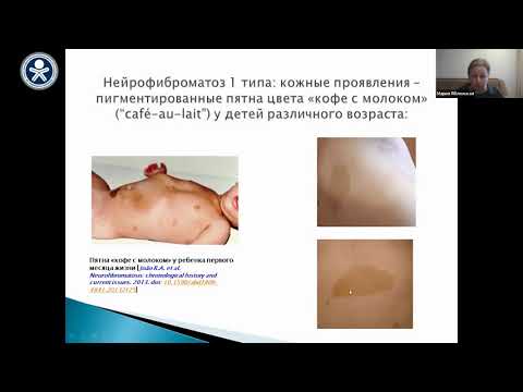 Видео: Нейрофиброматоз 1 типа у детей: клинические проявления, диагностика, подходы к лечению