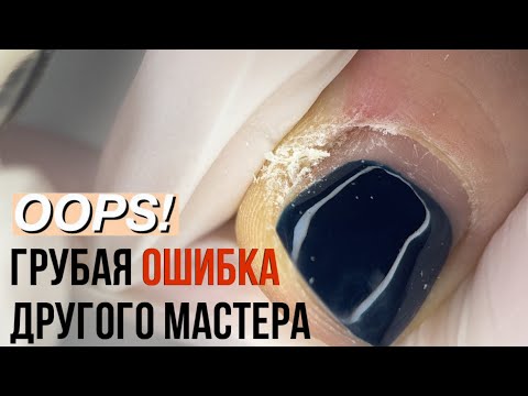 Видео: КАК МНЕ ЗАПОРОЛИ НОГТИ. Педикюр от другого мастера. Подногтевые мозоли. Вростание ногтей