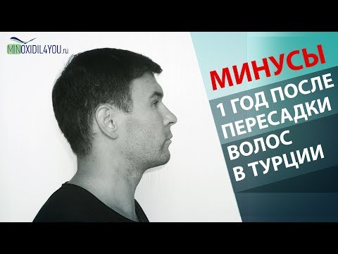 Видео: ПЕРЕСАДКА ВОЛОС В ТУРЦИИ 12 МЕСЯЦЕВ МИНУСЫ. Пересадка волос в Турции результат 2019. Minoxidil4you
